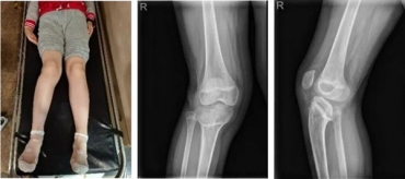 3D掃描+3D打印技術，開啟骨科微創(chuàng)精準矯正手術“私人定制”時代